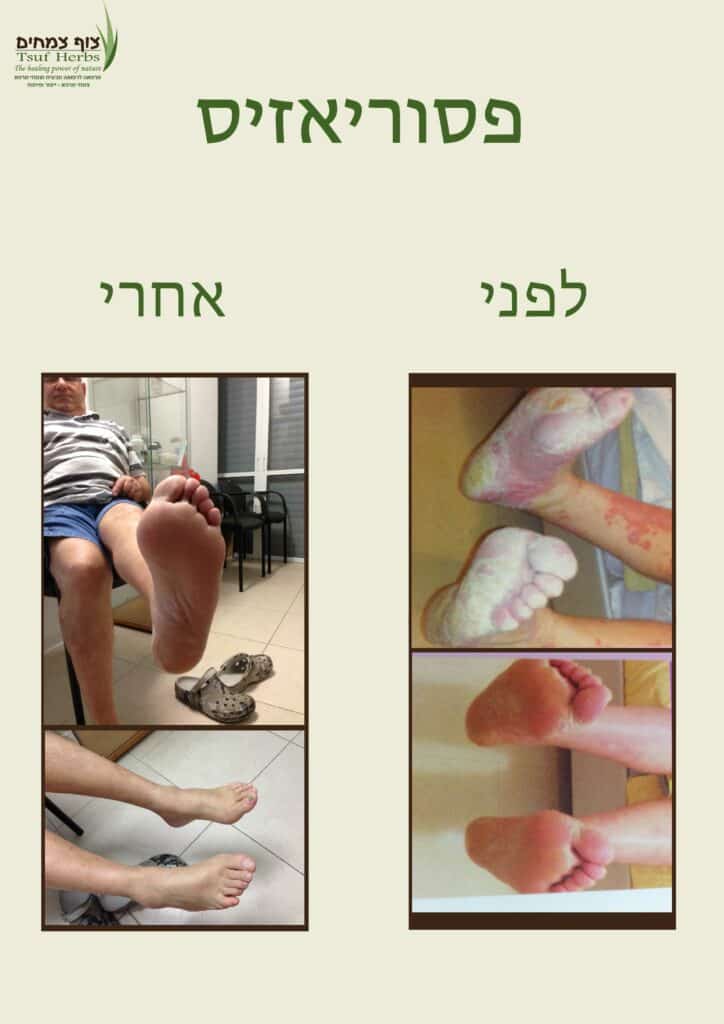 פסוריאזיס בכפות הרגליים - לפני ואחרי | צוף צמחים - רפואה טבעית