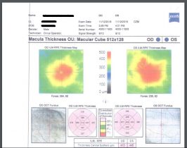 טיפול טבעי בבצקת בעין - אחרי