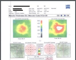 טיפול טבעי בבצקת בעין - לפני