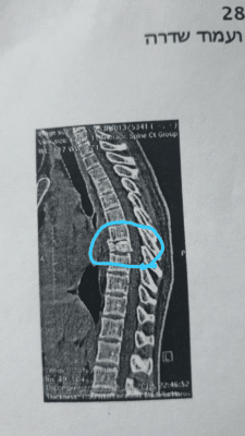 בעיות גב - שבר בחוליה, טיפול טבעי backpain treatment | צוף צמחים