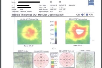 טיפול טבעי בבצקת בעין: הגישה ההוליסטית להפחתת נפיחות וסיוע מהשורש