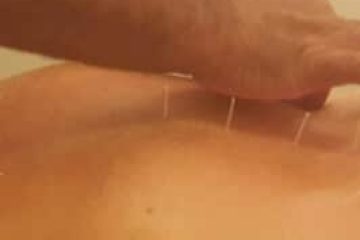 דיקור לאפילפסיה