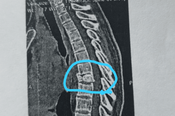 משוב של מתן: בעיות גב – שבר בחוליה